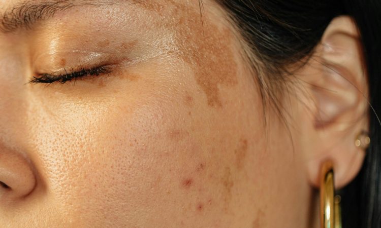 melasma